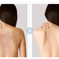 Xịt Trị Mụn Lưng Senakyua Kobayashi 100ml Xịt Trị Mụn Lưng Senakyua Kobayashi 100ml