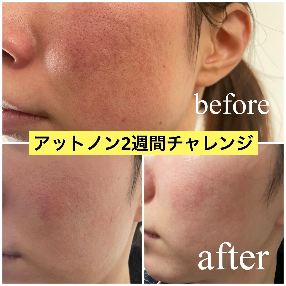 Gel Trị Thâm Mụn Kobayashi Atnon Acne Care 10g ニキビあとケアジェル|アットノンの口コミ - \お肌日記/ アットノン2週間の違いがこちら! by Daisy(混合肌/20代後半) | LIPS