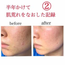 Nước Hoa Hồng Kiểm Soát Dầu Hỗ Trợ Giảm Mụn Meishoku Bigansui Skin Lotion Nước Hoa Hồng Kiểm Soát Dầu Hỗ Trợ Giảm Mụn Meishoku Bigansui Skin Lotion